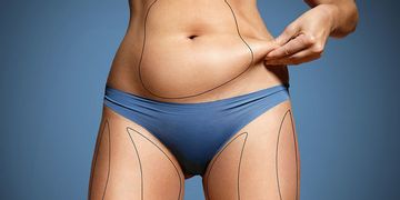 Tipos de abdominoplastia: ¿cuál se adapta mejor a cada caso?