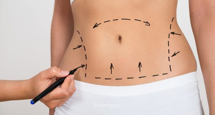 Todo sobre abdominoplastia