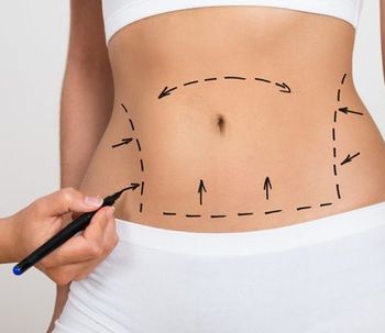 Todo sobre abdominoplastia