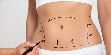 Todo sobre abdominoplastia