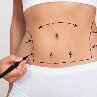 Todo sobre abdominoplastia