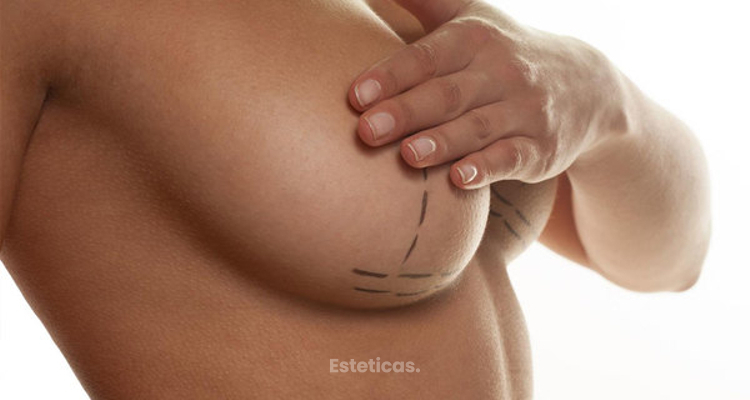 Mamoplastía de aumento