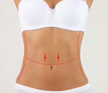 Las orejas de perro después de la abdominoplastia