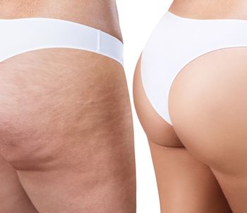 Los mejores tratamientos para la celulitis