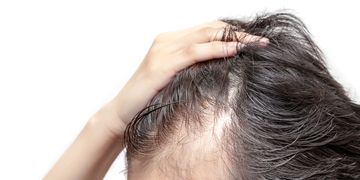 Cómo tratar la caída del cabello