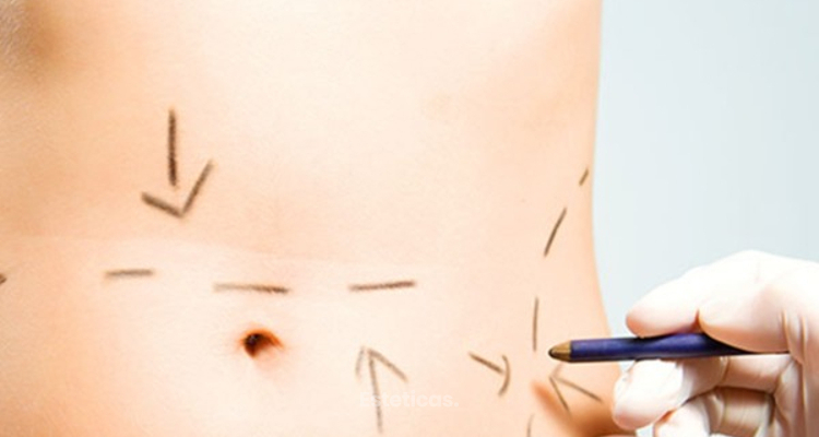 Abdominoplastia, ¿por qué deberías hacertela?