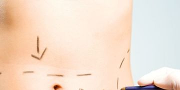 Abdominoplastia, ¿por qué deberías hacertela?