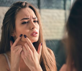 Cuidar la piel en el tratamiento del acné