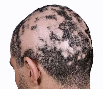 Causas de la Caída del Cabello