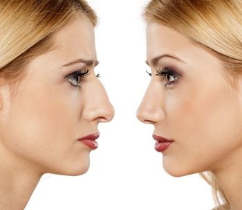 El uso de hilos tensores en la rinoplastia