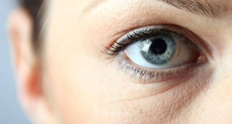 El laserlipólisis en el tratamiento de las bolsas en los ojos