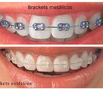 cuanto salen los brackets invisibles cuanto salen los brackets invisibles