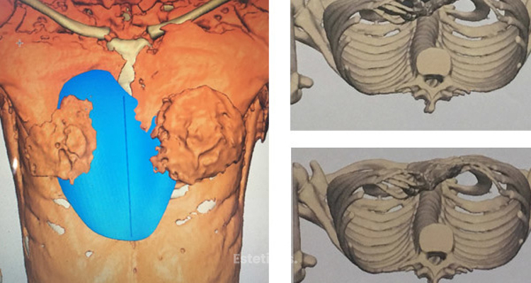 Cirugía revolucionaria ofrece esperanza a personas con malformaciones congénitas con implante 3D