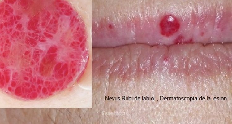 Dermatoscopía: diagnóstico de lesiones de la piel