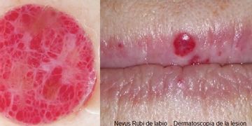 Dermatoscopía: diagnóstico de lesiones de la piel Dermatoscopía: diagnóstico de lesiones de la piel