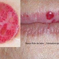 Dermatoscopía: diagnóstico de lesiones de la piel