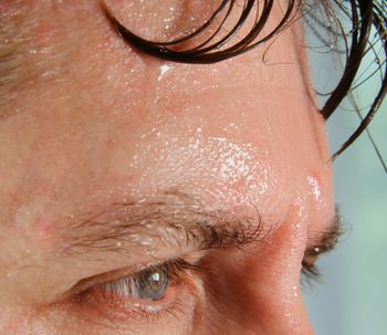 Qué es la hiperhidrosis y cómo se trata