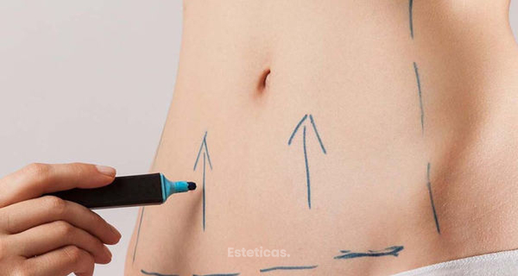 Cuál es el procedimiento para recuperar un contorno abdominal