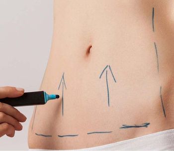 Cuál es el procedimiento para recuperar un contorno abdominal