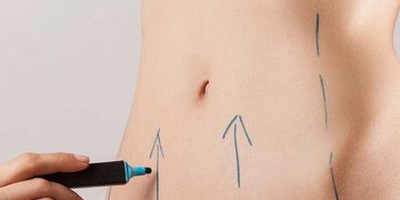 Cuál es el procedimiento para recuperar un contorno abdominal