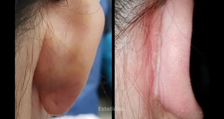 Otoplastia: ¿Qué provoca las orejas en asa o prominentes?