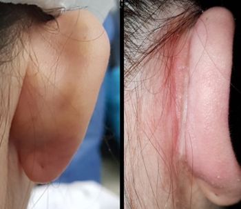 Otoplastia: ¿Qué provoca las orejas en asa o prominentes?