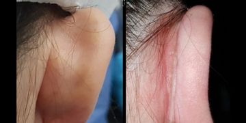 Otoplastia: ¿Qué provoca las orejas en asa o prominentes?