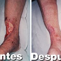 Enfermedad venosa crónica