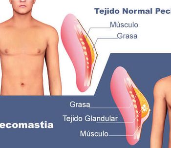 Ginecomastia / Mama masculina