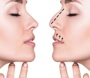 Información sobre Rinoplastia