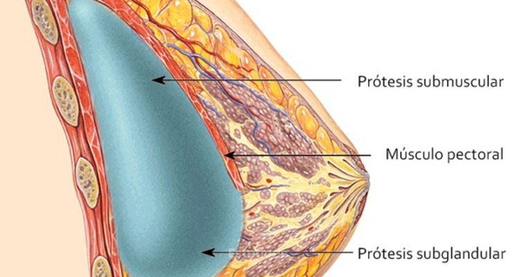 ¿Prótesis de mama por encima o por debajo del músculo? ¿Qué es mejor?