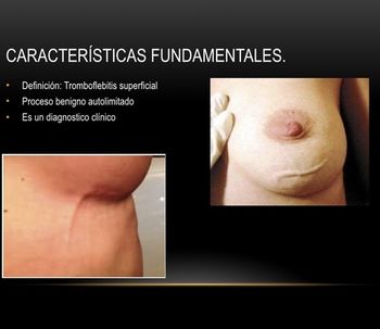 Enfermedad de Mondor post implantes