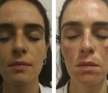 Nuevo Láser Harmony XL: Post tratamiento para manchas faciales