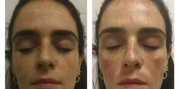 Nuevo Láser Harmony XL: Post tratamiento para manchas faciales