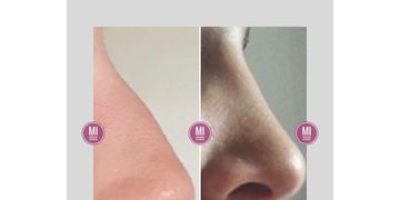 Lo nuevo en Rinoplastia.