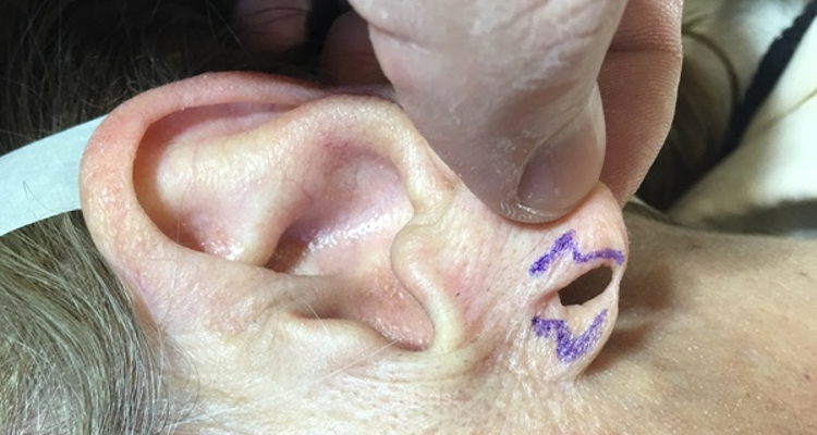 Tratamiento del lóbulo auricular hendido