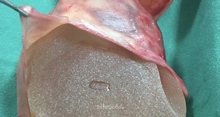 Contractura capsular de implantes mamarios