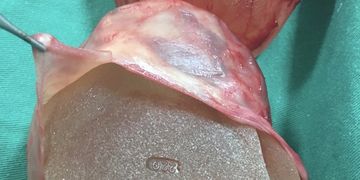 Contractura capsular de implantes mamarios