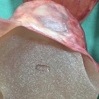 Contractura capsular de implantes mamarios