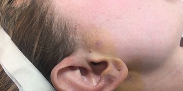 Corrección de la posición y tamaño de las orejas