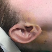 Corrección de la posición y tamaño de las orejas