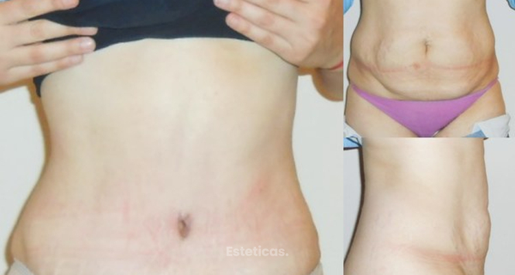 Abdominoplastía ¿cuánto duele?