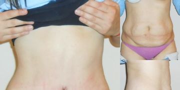 Abdominoplastía ¿cuánto duele?