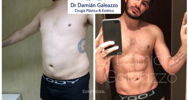 Marcación Abdominal