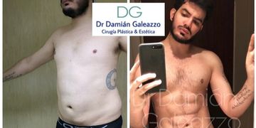 Marcación Abdominal Marcación Abdominal