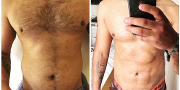 ¿Qué es y en qué consiste la Lipomarcación?