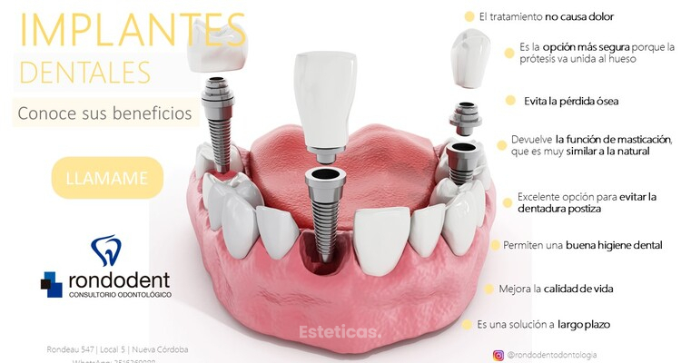 Implantes dentales: devuelve a tu boca su estética y funciones naturales