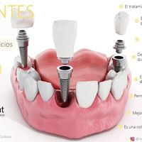 Implantes dentales: devuelve a tu boca su estética y funciones naturales
