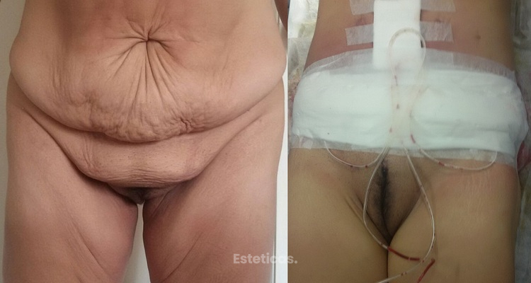 Dermolipectomía en Abdómenes Péndulos