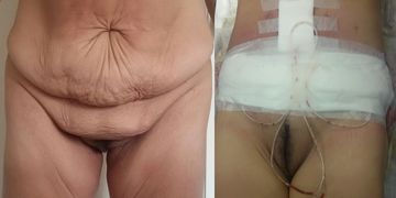 Dermolipectomía en Abdómenes Péndulos